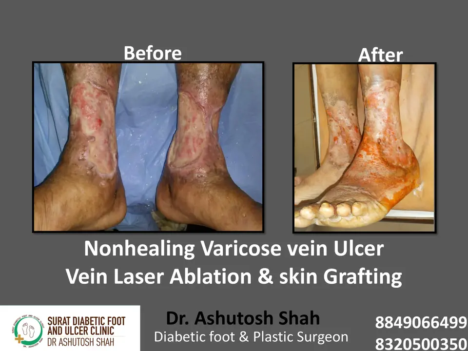 Varicose veins and Ulcers.pptx-8.webp